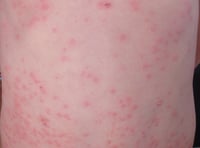 Two measles cases confirmed in Gwent says PHW