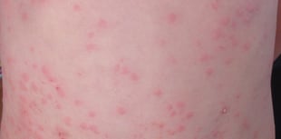Measles 'outbreak' declared in Gwent as more cases confirmed