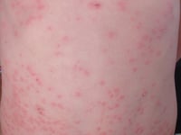 Gwent measles outbreak is over 