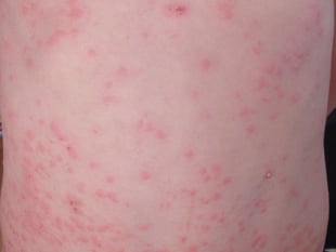 Measles 'outbreak' declared in Gwent as more cases confirmed