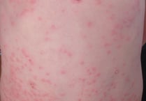 Two measles cases confirmed in Gwent says PHW