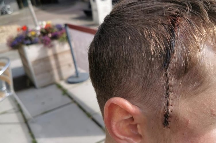 Scott after brain surgery. A fit mountain climber was diagnosed with cancer after experiencing a seizure - despite ignoring headaches and nosebleeds, he now believes to have been "warning signs". Scott Hinch, 29, led a fit and active lifestyle and, despite "experiencing a few headaches and nosebleeds", had no prior significant health problems. But on his way to work on 19 August 2019, he suffered a seizure and was rushed to Neville Hall Hospital. He was put into a four-day coma and - after waking up -  an MRI revealed a grade 2 astrocytoma - and he was given three to five years to live.  