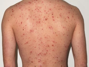 Wales begins chickenpox vaccine rollout